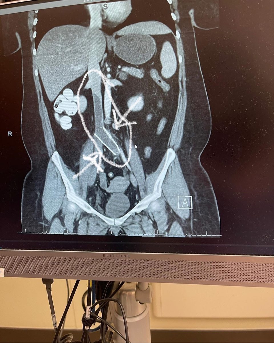 CT scan from December 2020 showing the blood clot, with the affected area circled